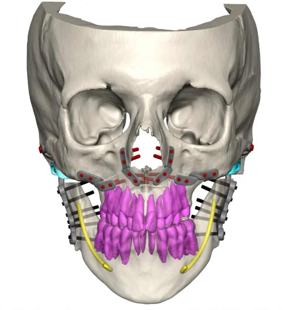 3D surgical plan showing custom titanium total joint prostheses fitted to both jaw joints